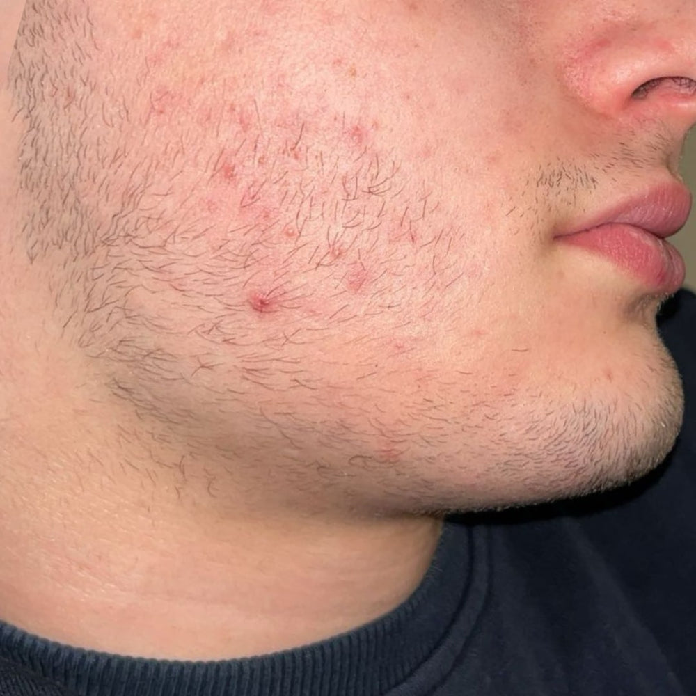 rastezh_na_brada_slider_predi